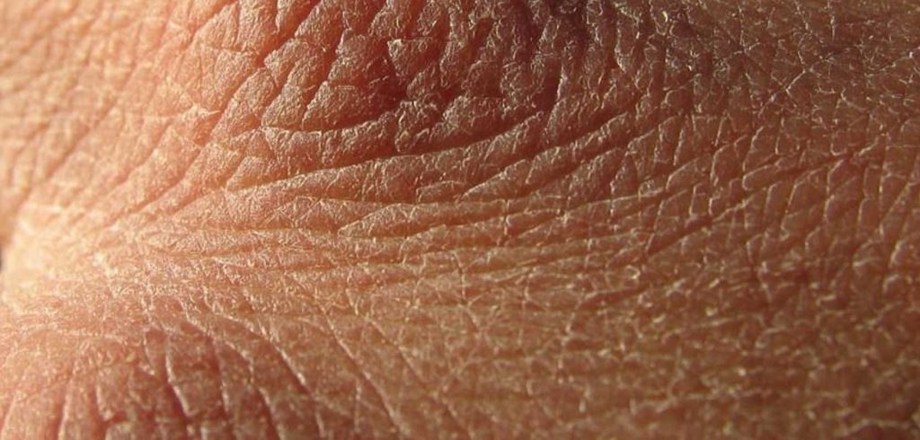 Symptoms Of Dehydration You're Probably Ignoring