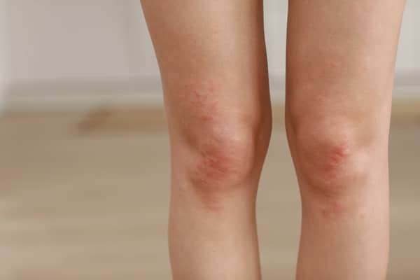 Silent Symptoms of Poor Circulation